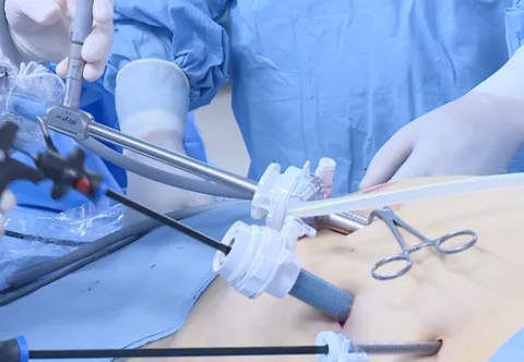 Các yếu tố ảnh hưởng đến hiệu quả giảm cân sau phẫu thuật nội soi thu nhỏ dạ dày